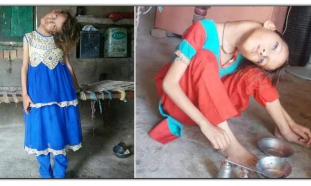 माता पिता की एक भूल की वजह से सजा भुगत रही है ये लड़की, हमेशा के लिए मूड गई 90 डिग्री गरदन