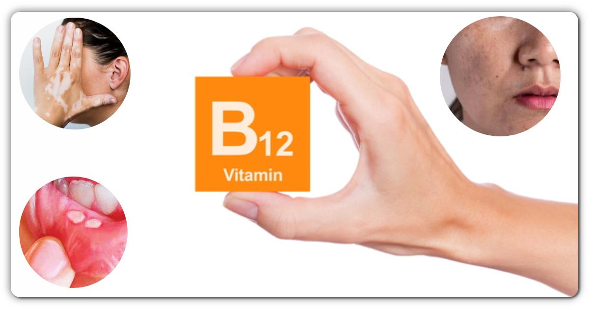 यदि शरीर में विटामिन बी 12 कम हो जाता है, तो ऐसे लक्षण दिखाई देते हैं, और गंभीर बीमारियां हो सकती हैं, शाकाहारी जरूर पढे