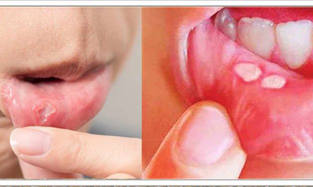 क्या आपको मुंह के छाले हैं? तो उसको दूर करने के लिए इन 6 तरकीबों का पालन करें, 2 दिन मे छाले गायब