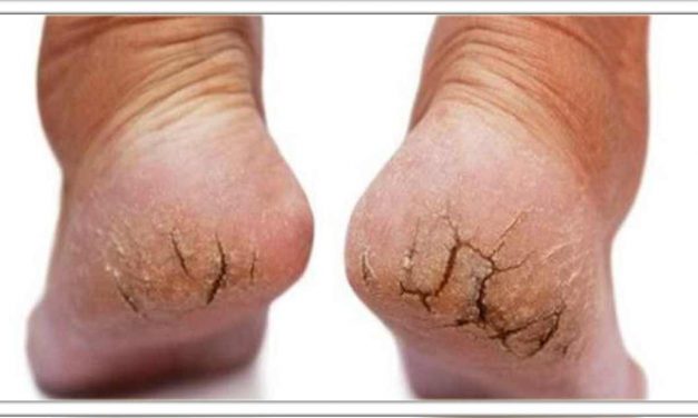 फटी एड़ियों को ठीक करने के लिए अपनाए यह उपाय, कुछ ही दिनों में मुलायम कर देगा।