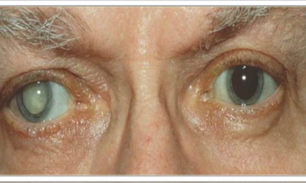 इस आयुर्वेदिक उपचार से बिना दवा के सिर्फ 5 दिनों में मोतियाबिंद, पीलिया, सूजन जैसी आंखों की हर समस्या से छुटकारा मिल जाएगा।