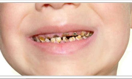 छोटे बच्चे को चॉकलेट खाकर दांत खराब हो गए है, दांत हीरे जैसे चमकेंगे। जानिए इस प्राकृतिक अमूल्य वस्तु के सेवन के फायदे।
