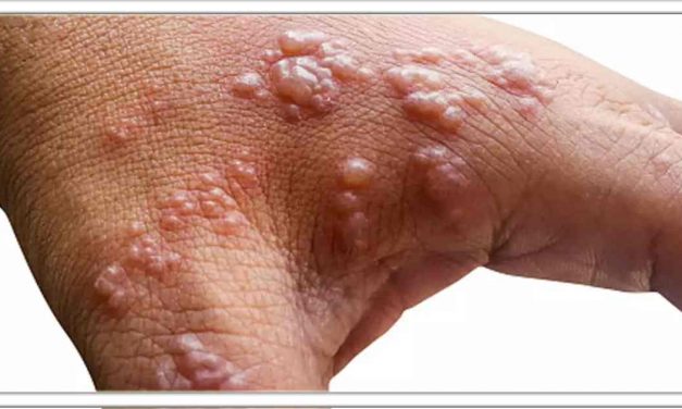 हर्पीस जैसी भयानक चर्म रोग को दूर करने के लिए अपनाए यह आयुर्वेदिक उपचार