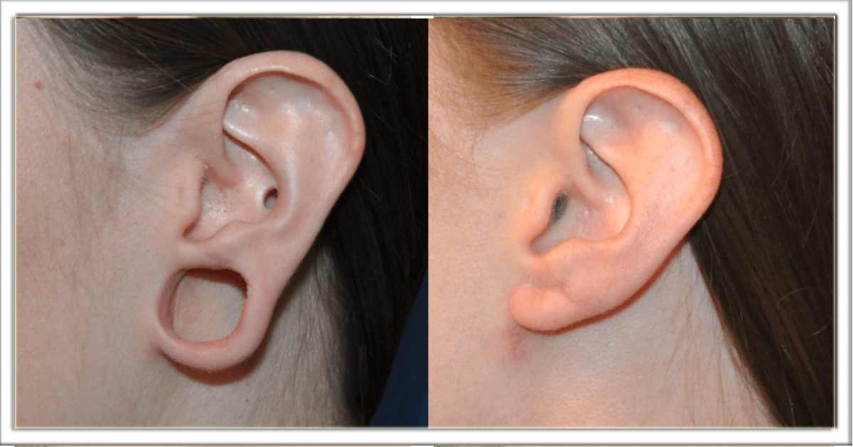 यदि आपके कान भी बहुत बड़े हो रहे हैं, तो अपनाई यह सबसे सरल उपाय, छेद छोटा हो जाएगा