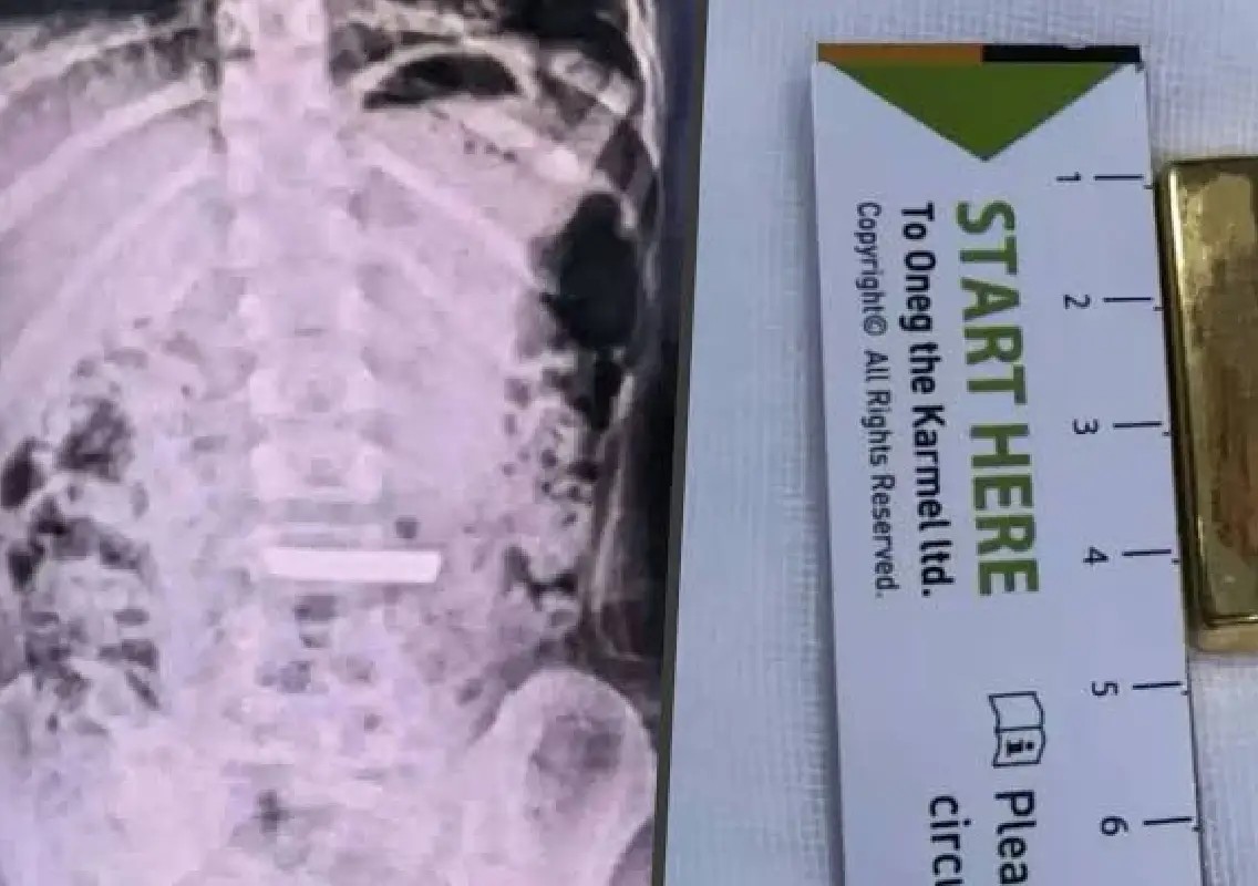 five-year-old-girl-hospitalised-after-swallowing-50-gram-gold-bar